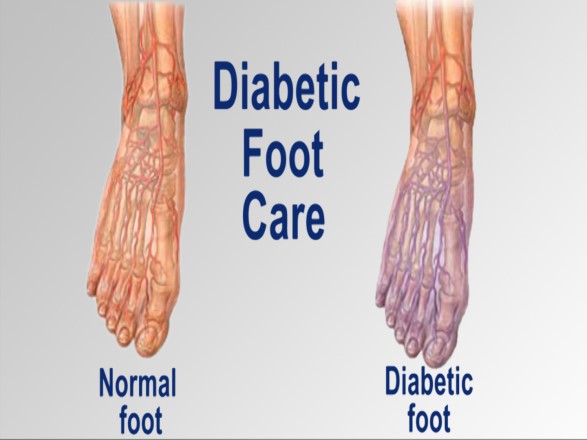 diabetic-foot-care4