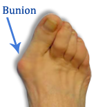 Foot surgery is the only cure for bunionse 